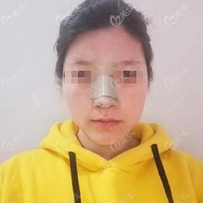 鼻綜合術(shù)后第三天 鼻綜合術(shù)后第三天