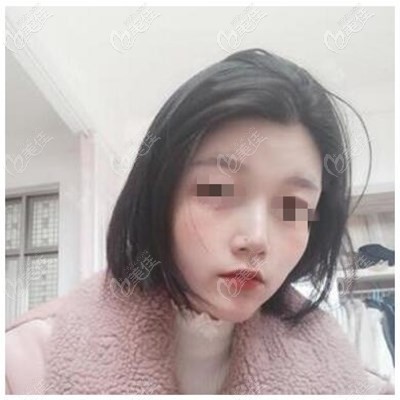 鼻綜合術(shù)后3個(gè)月 鼻綜合術(shù)后3個(gè)月