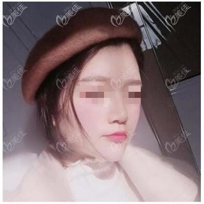 以為做立秀膨體隆鼻墊8mm會(huì)太高了,恢復(fù)一年后感覺(jué)也不是很夸張