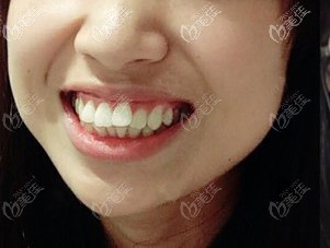 到合肥壹加壹口腔做牙齒矯正前 到合肥壹加壹口腔做牙齒矯正前