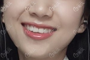 來吧，跟我一起體驗(yàn)合肥壹加壹做時(shí)代天使牙齒矯正的全過程，正規(guī)有保障