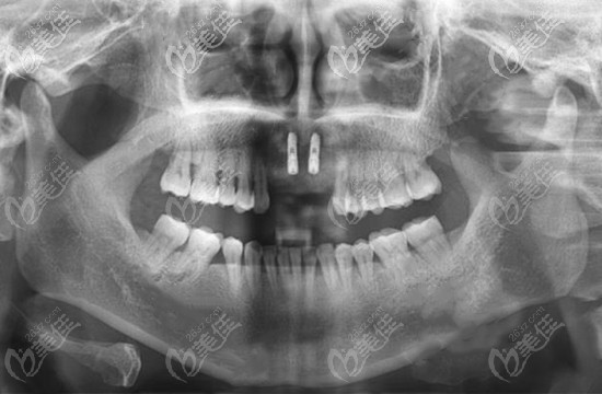 上門牙缺失4顆種植方案 上門牙缺失4顆種植方案