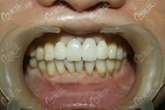 門牙缺失四顆種植案例圖片 門牙缺失四顆種植案例圖片