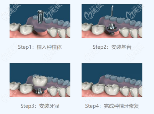 種植牙的基本流程 種植牙的基本流程