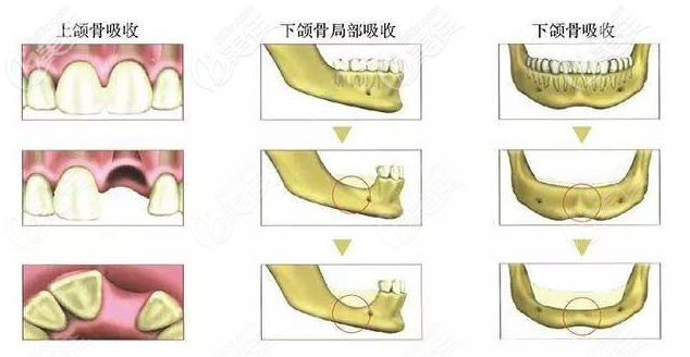 頜骨吸收導(dǎo)致的牙槽骨萎縮圖 頜骨吸收導(dǎo)致的牙槽骨萎縮圖
