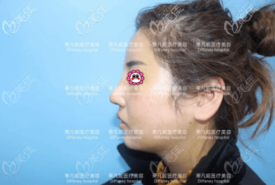 我做肋軟骨鼻綜合手術(shù)有18天了