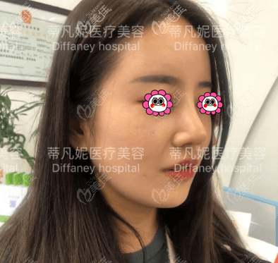 術(shù)后一個(gè)月多一日樣子