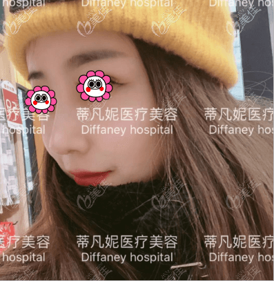 靳玉彪給我做的肋軟骨鼻綜合效果