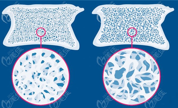 骨質(zhì)疏松癥對(duì)種植牙的影響 骨質(zhì)疏松癥對(duì)種植牙的影響
