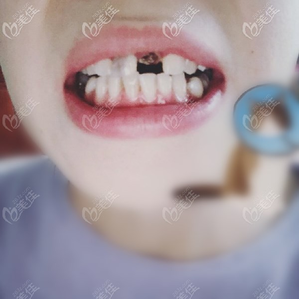 分享我在濟(jì)南美奧口腔種植上門牙的親身經(jīng)歷