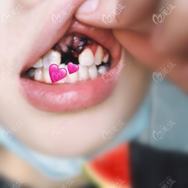 門牙拔除殘根后縫合 門牙拔除殘根后縫合