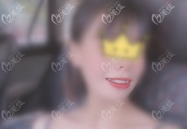 門牙種植恢復(fù)后照片 門牙種植恢復(fù)后照片