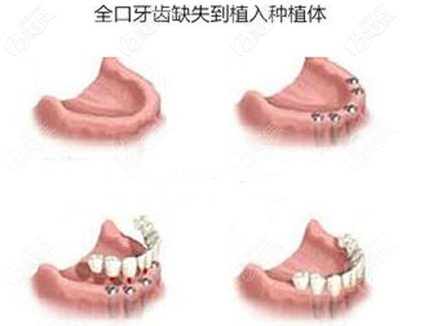 全口缺失種植牙的示意圖 全口缺失種植牙的示意圖
