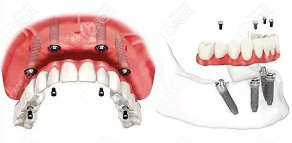 無牙頜種植allon4的技術(shù) 無牙頜種植allon4的技術(shù)