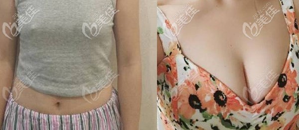 做完曼托225cc假體隆胸恢復(fù)半年后效果圖片