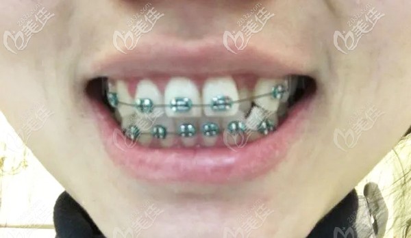 戴了兩年的金屬自鎖托槽 戴了兩年的金屬自鎖托槽