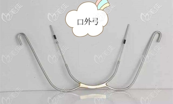 正畸口外弓介紹 正畸口外弓介紹