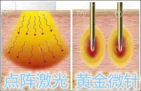 黃金微針和點(diǎn)陣哪個(gè)好