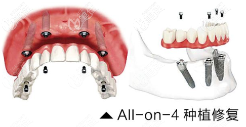 All-on-4即刻種植圖示