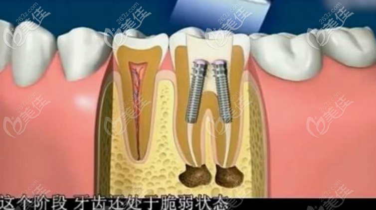 牙齒根管治療圖示