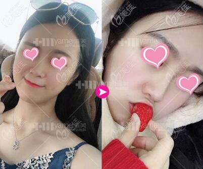 注射玻尿酸隆鼻術(shù)前術(shù)后對(duì)比照 注射玻尿酸隆鼻術(shù)前術(shù)后對(duì)比照