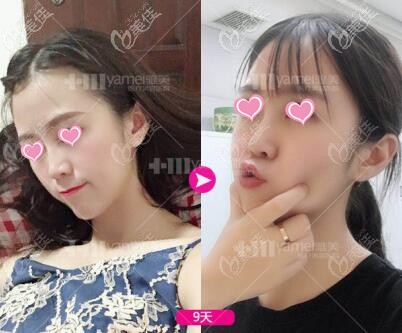 注射玻尿酸隆鼻術(shù)后9天照 注射玻尿酸隆鼻術(shù)后9天照