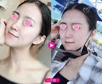 玻尿酸隆鼻術(shù)后1個(gè)月效果照 玻尿酸隆鼻術(shù)后1個(gè)月效果照