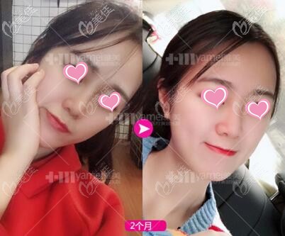 我在長沙雅美注射喬雅登玻尿酸隆鼻2個月效果分享