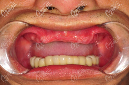 半口缺牙 半口缺牙