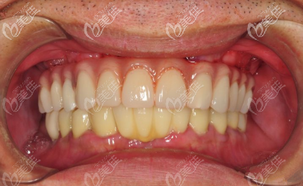 西安林牙立齒口腔<諾貝爾Active上半口6顆植牙案例>