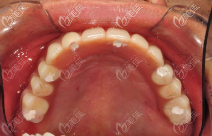 上頜種植后效果 上頜種植后效果