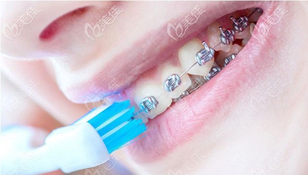 在秦皇島矯正牙齒大概多少錢你想了解么?可參考藍(lán)天口腔正畸收費(fèi)哦