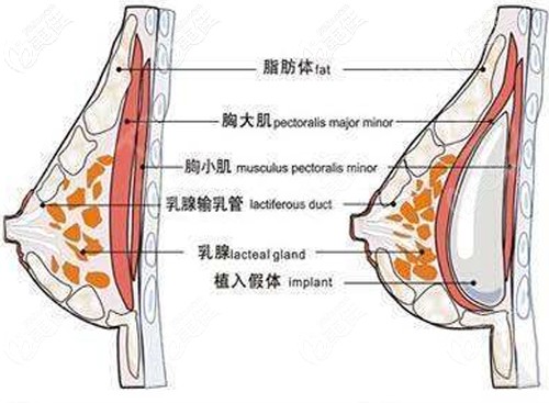 假體隆胸植入層次示意圖