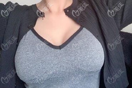 做傲諾拉閃耀假體隆胸術(shù)后一個(gè)半月效果 做傲諾拉閃耀假體隆胸術(shù)后一個(gè)半月效果