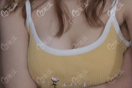 剛做完傲諾拉閃耀假體隆胸兩個(gè)乳房中間分得太開,3個(gè)月后胸就變聚攏了