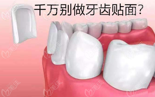 牙齒貼面好不好 牙齒貼面好不好