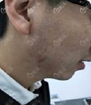 下頦痘痘增生性瘢痕