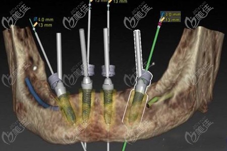 allon4種植牙圖解 allon4種植牙圖解