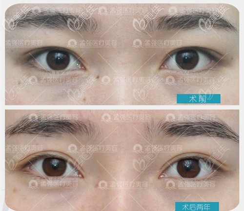 雙眼皮失敗修復(fù)案例 雙眼皮失敗修復(fù)案例