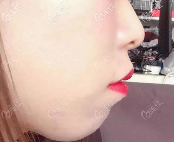 側(cè)面看嘴巴突的很厲害，下巴都沒了