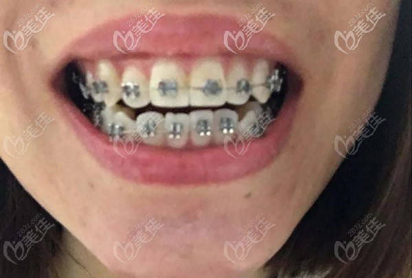 我是先戴的鋼牙套才拔的牙哦