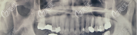 術前的口腔片 術前的口腔片