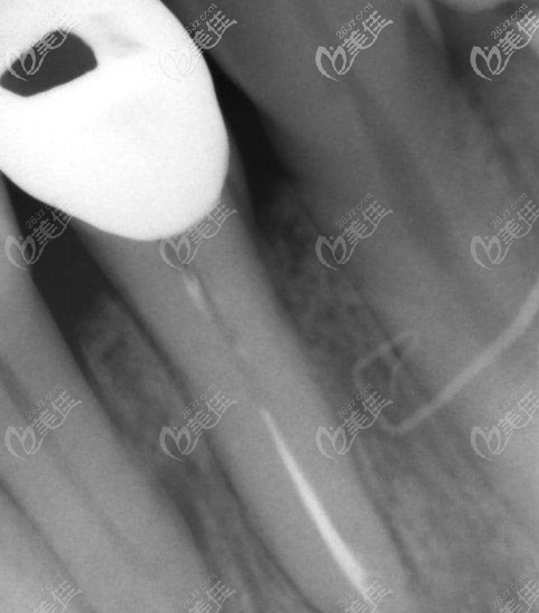 第二次拍牙膠尖照片 第二次拍牙膠尖照片