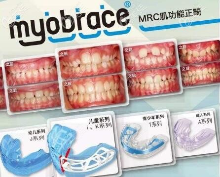 mrc早期干預(yù)矯正 mrc早期干預(yù)矯正