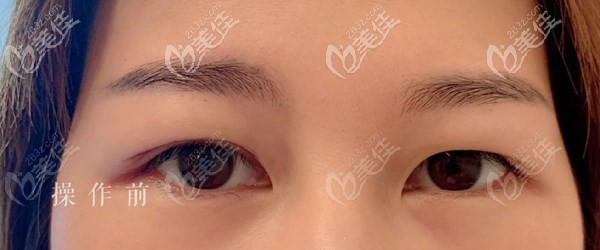 因?yàn)橘N雙眼皮貼導(dǎo)致眼皮松弛出現(xiàn)“雙眼皮” 因?yàn)橘N雙眼皮貼導(dǎo)致眼皮松弛出現(xiàn)“雙眼皮”