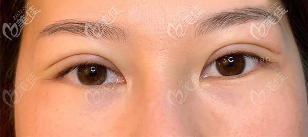 南充艾迪曾少林切開(kāi)雙眼皮術(shù)后效果 南充艾迪曾少林切開(kāi)雙眼皮術(shù)后效果