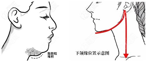 雙下巴吸脂和下頜緣吸脂可以同時(shí)進(jìn)行 雙下巴吸脂和下頜緣吸脂可以同時(shí)進(jìn)行