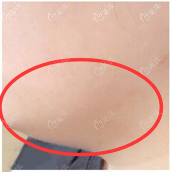 下頜緣吸脂前 下頜緣吸脂前