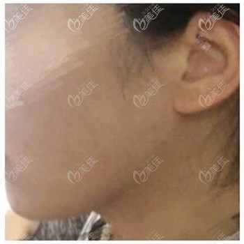 雙下巴和下頜緣同時(shí)吸脂后 雙下巴和下頜緣同時(shí)吸脂后