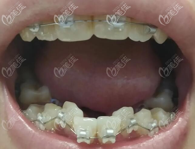 下排牙齒擁擠初戴陶瓷牙套的照片